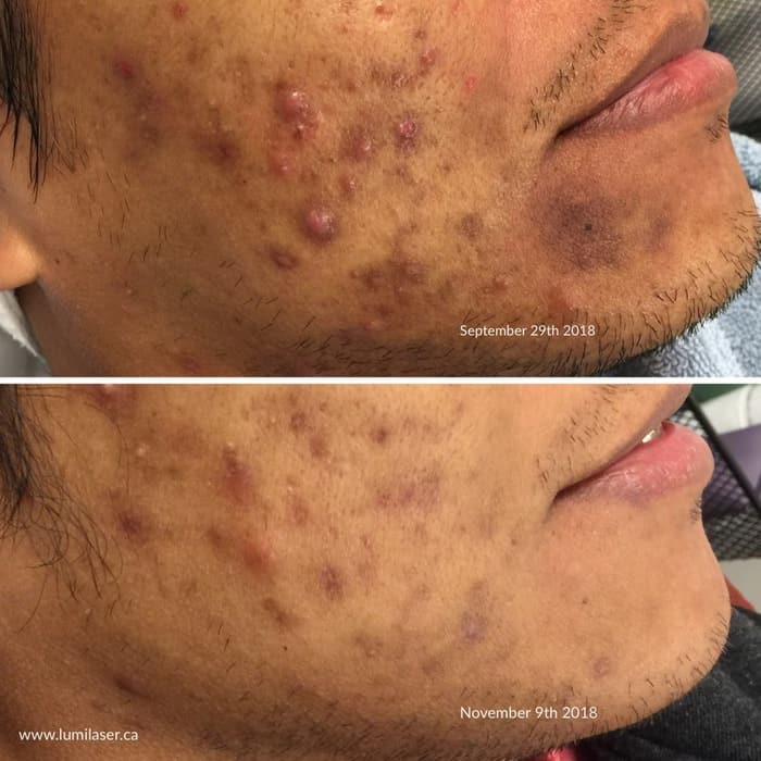 Vết thâm mụn - Hyperpigmentation