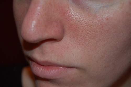To lỗ chân lông - gel lột mụn