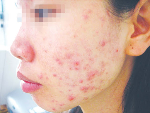 Mặt bị nổi mụn nhiều hơn