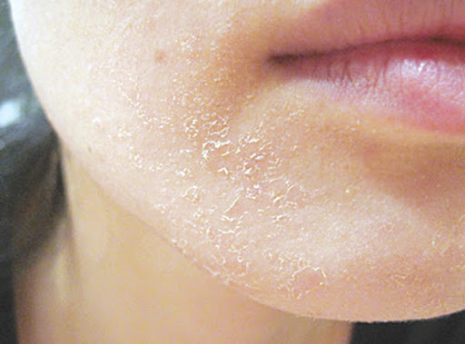 Viêm da tiếp xúc - Contact Dermatitis
