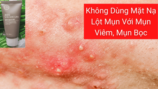 Không dùng mặt nạ lột mụn cho mụn viêm, mụn bọc