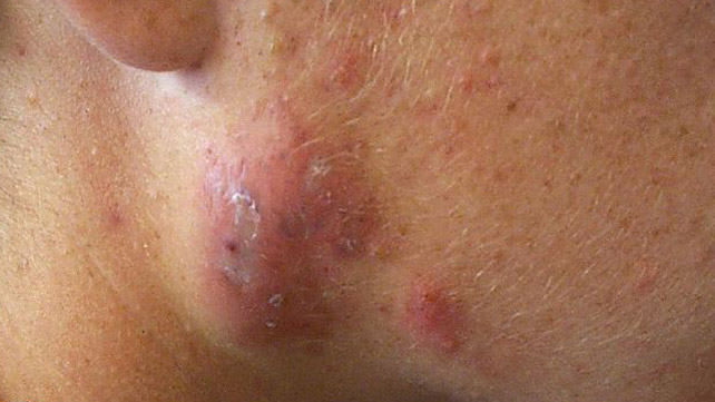 Nhiễm trùng mụn trứng cá